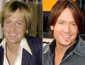 Keith Urban before and after plastic surgery 12