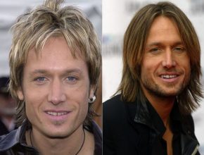 Keith Urban before and after plastic surgery 22