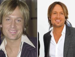 Keith Urban before and after plastic surgery