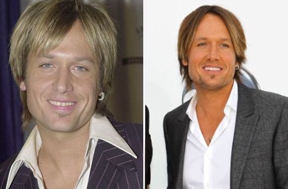 Keith Urban before and after plastic surgery