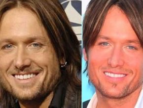 Keith Urban plastic surgery 3