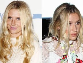 Kesha before and after plastic surgery