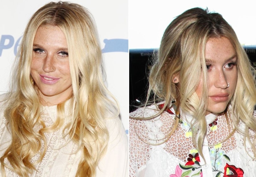 Kesha before and after plastic surgery