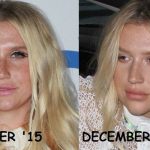 Kesha before and after plastic surgery 27