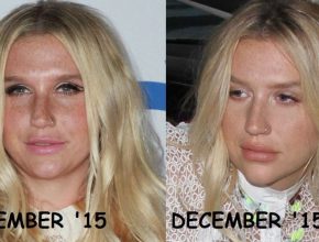 Kesha before and after plastic surgery 27