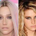 Kesha before and after plastic surgery 37