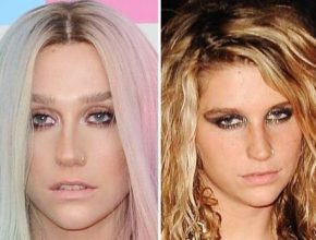 Kesha before and after plastic surgery 37