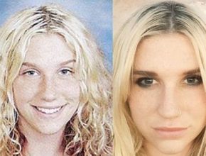 Kesha before and after plastic surgery 38