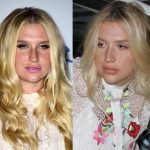 Kesha before and after plastic surgery 44