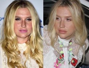 Kesha before and after plastic surgery 44