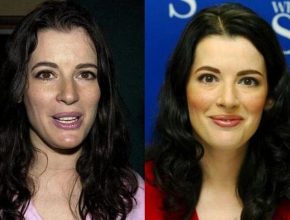 Nigella Lawson before and after plastic surgery