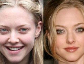 Amanda Seyfried before and after plastic surgery (18)