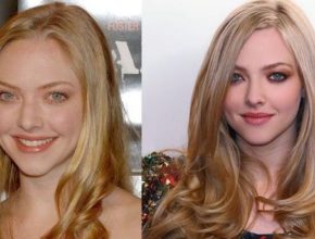 Amanda Seyfried before and after plastic surgery