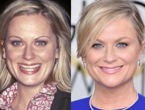 Amy Poehler before and after plastic surgery (32)