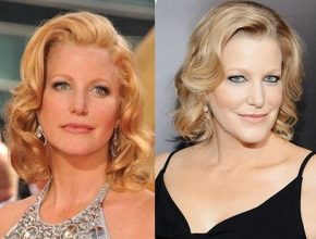 Anna Gunn before and after plastic surgery
