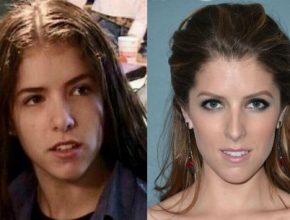 Anna Kendrick before and after plastic surgery (19)