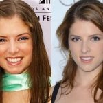Anna Kendrick before and after plastic surgery (28)