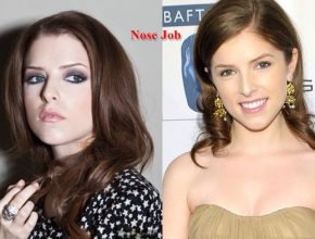 Anna Kendrick before and after plastic surgery