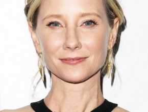 Anne Heche plastic surgery (01)