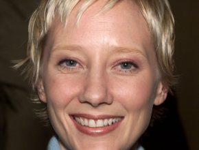 Anne Heche plastic surgery (1)