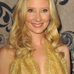 Anne Heche plastic surgery (28)