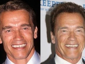 Arnold Schwarzenegger before and after plastic surgery