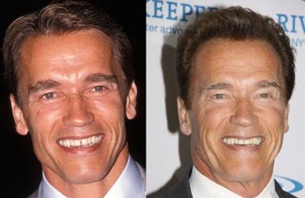 Arnold Schwarzenegger before and after plastic surgery