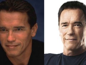Arnold Schwarzenegger before and after plastic surgery (21)