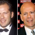 Bruce Willis before and after plastic surgery (12)