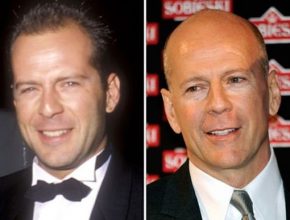 Bruce Willis before and after plastic surgery (12)