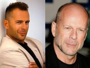 Bruce Willis before and after plastic surgery