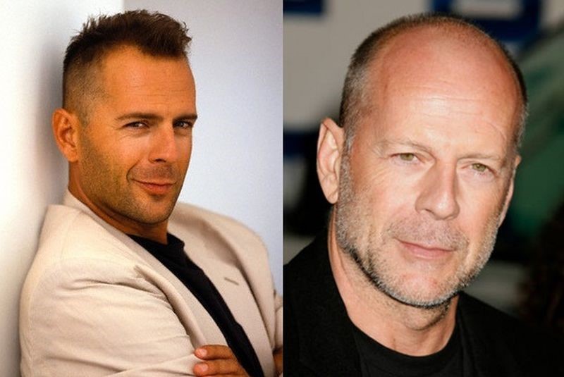 Bruce Willis before and after plastic surgery