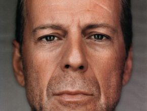 Bruce Willis plastic surgery (9)