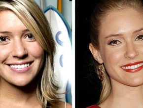 Kristin Cavallari before and after plastic surgery