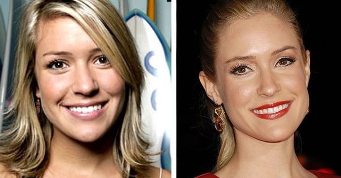 Kristin Cavallari before and after plastic surgery