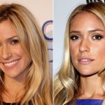 Kristin Cavallari before and after plastic surgery (16)
