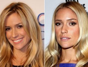 Kristin Cavallari before and after plastic surgery (16)