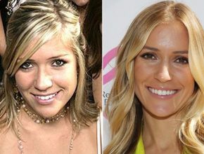 Kristin Cavallari plastic surgery (57)
