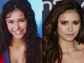 Nina Dobrev before and after plastic surgery
