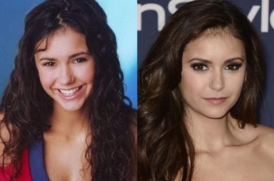 Nina Dobrev before and after plastic surgery.