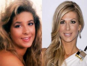 Alexis Bellino before and after plastic surgery