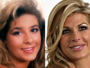 Alexis Bellino before and after plastic surgery (20)