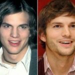 Ashton Kutcher before and after plastic surgery (18)