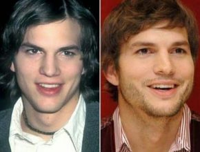 Ashton Kutcher before and after plastic surgery (18)