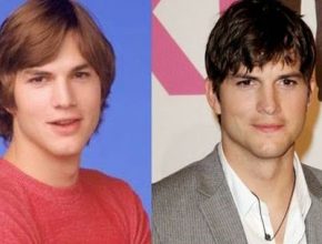 Ashton Kutcher before and after plastic surgery (19)