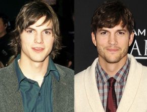 Ashton Kutcher before and after plastic surgery