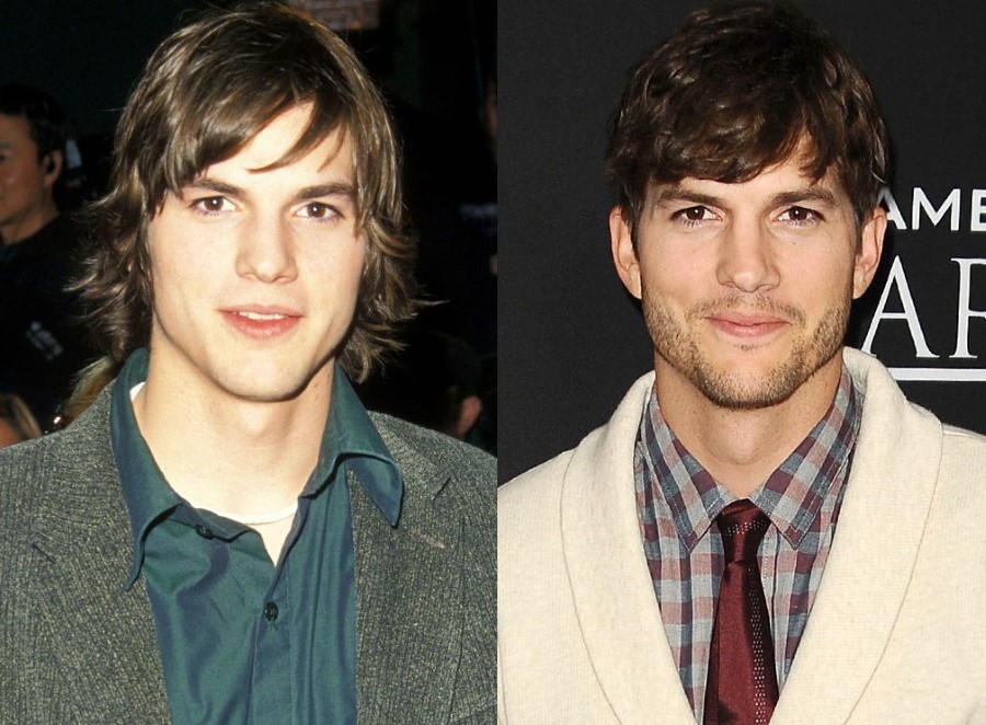 Ashton Kutcher before and after plastic surgery