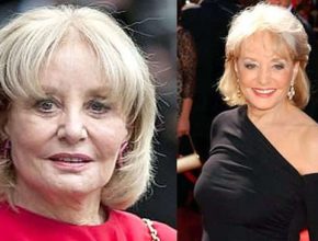 Barbara Walters before and after plastic surgery (9)