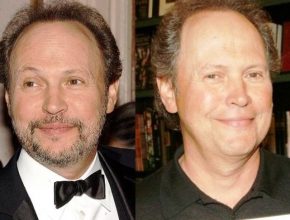 Billy Crystal before and after plastic surgery (1)