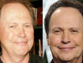 Billy Crystal before and after plastic surgery (2)